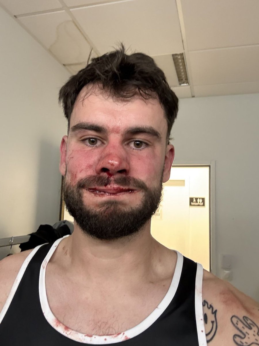 360actufr's tweet photo. L’état du visage de LeBouseuh après son combat contre Prime au #DTRFight 🥊 https://t.co/pD1j0dIco4