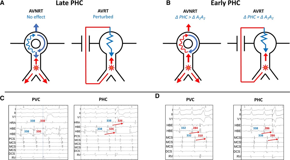 Brock Gambill (@forkknifecab_ep) on Twitter photo Premature His Bundle Complexes distinguished AVRT and AVNRT with 100% Specificity and Sensitivity irrespective of location.
A simple & intuitive maneuver.
PHC delivered 42 msec ahead of HIS, perturbed A1-A2 by 15 msec = AVNRT.
<a href="/PadanilamBenzy/">Benzy Padanilam</a>
<a href="/Ashit_EPS/">Ashit Patel</a>
<a href="/EP_EmilyS/">Emily Shaw</a> Premature His Bundle Complexes distinguished AVRT and AVNRT with 100% Specificity and Sensitivity irrespective of location.
A simple & intuitive maneuver.
PHC delivered 42 msec ahead of HIS, perturbed A1-A2 by 15 msec = AVNRT.
<a href="/PadanilamBenzy/">Benzy Padanilam</a>
<a href="/Ashit_EPS/">Ashit Patel</a>
<a href="/EP_EmilyS/">Emily Shaw</a>
