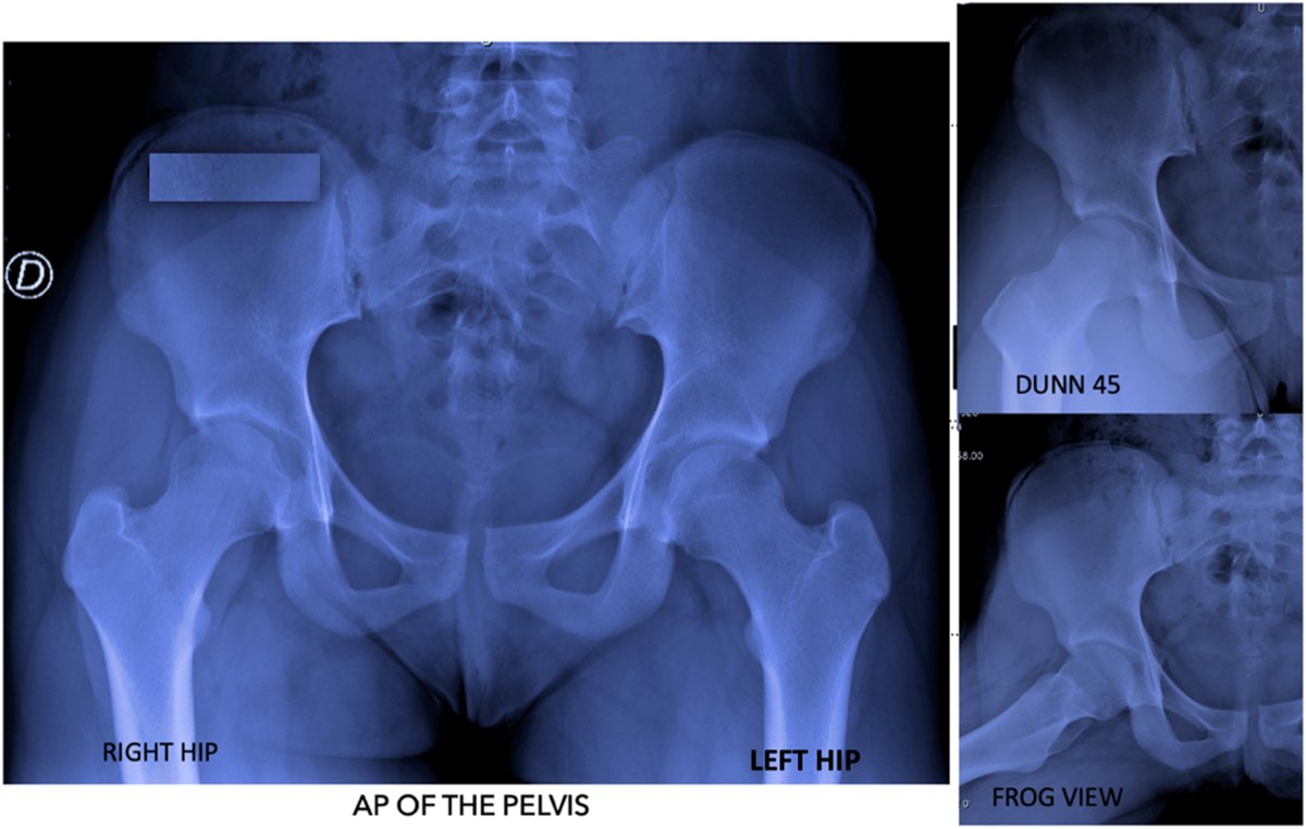 ArthroscopyJ's tweet photo. Postless Hip Arthroscopy for Labrum Reconstruction and Labrum Augmentation #hip #arthroscopy #labrum #reconstruction https://t.co/MlPtjIhKIr https://t.co/VFIu691LDM