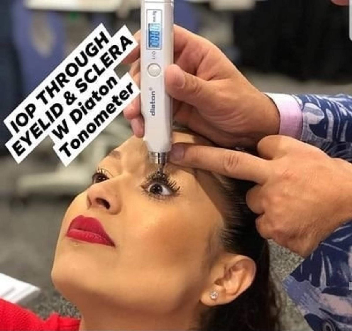 TONOMETER's tweet photo. Diaton Tonometer: A Paradigm Shift in IOP Measurement for Enhanced Patient Care and Practice Efficiency
https://t.co/DtIXy8QPdy
IOP THROUGH EYELID
#tonometer #tonometry #diaton #glaucoma #intraocularpressure #eyecare #optometry #ophthalmology #blindness #IOP https://t.co/q8v721Ck9I