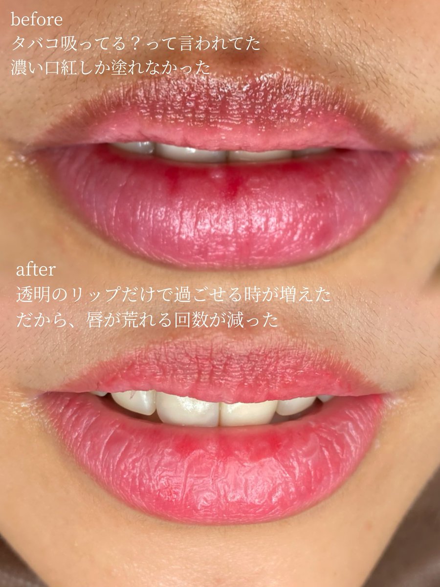 artmake__mayu's tweet photo. いつも唇の色が悪く、
「タバコ吸ってる？」っと言われてたお客様。

リップアートメイクでここまで良くなった🙌🏻💕 https://t.co/7Oidu6kIrk