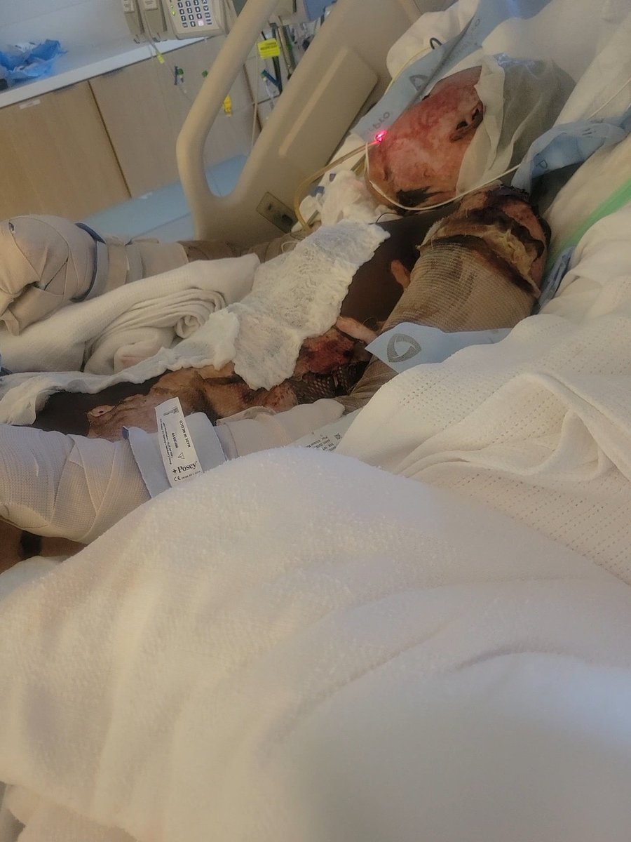traniya03's tweet photo. @Pastor__West My family is in desperate need of support during this very difficult time. My granddaughter was burned 80 percent of her body 3rd degree. Eight months later,we're still in ICU
#helpsupport #burnedgrandchildren
#donatenow #broken
https://t.co/NwUCBAOJ32 https://t.co/C1PTcLQAIL
