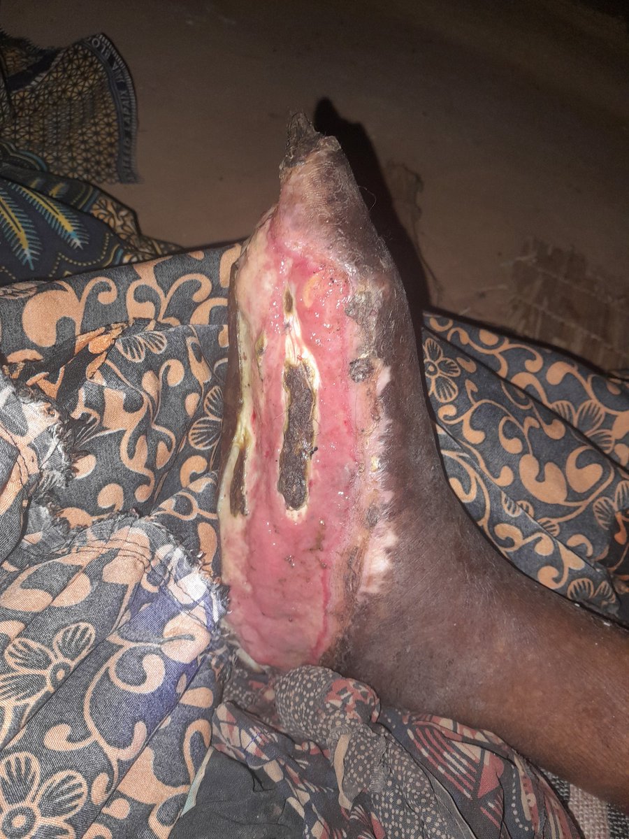 furaha_nzunda's tweet photo. #Msaada wa ushauri.
Bibi yangu ana shida hii ya miguu kidonda kikubwa, amepatiwa matibabu Hospital wilaya Vwawa Mbozi na Ilasi.

Tatizo limezidi na kufikia hatua ambayo familia inakata tamaa.

Kwa ushauri wa dawa, na matibabu tutashukuru.
@BongeLaAfya @Kudu_ze_Kudu https://t.co/beAkv7ogPO
