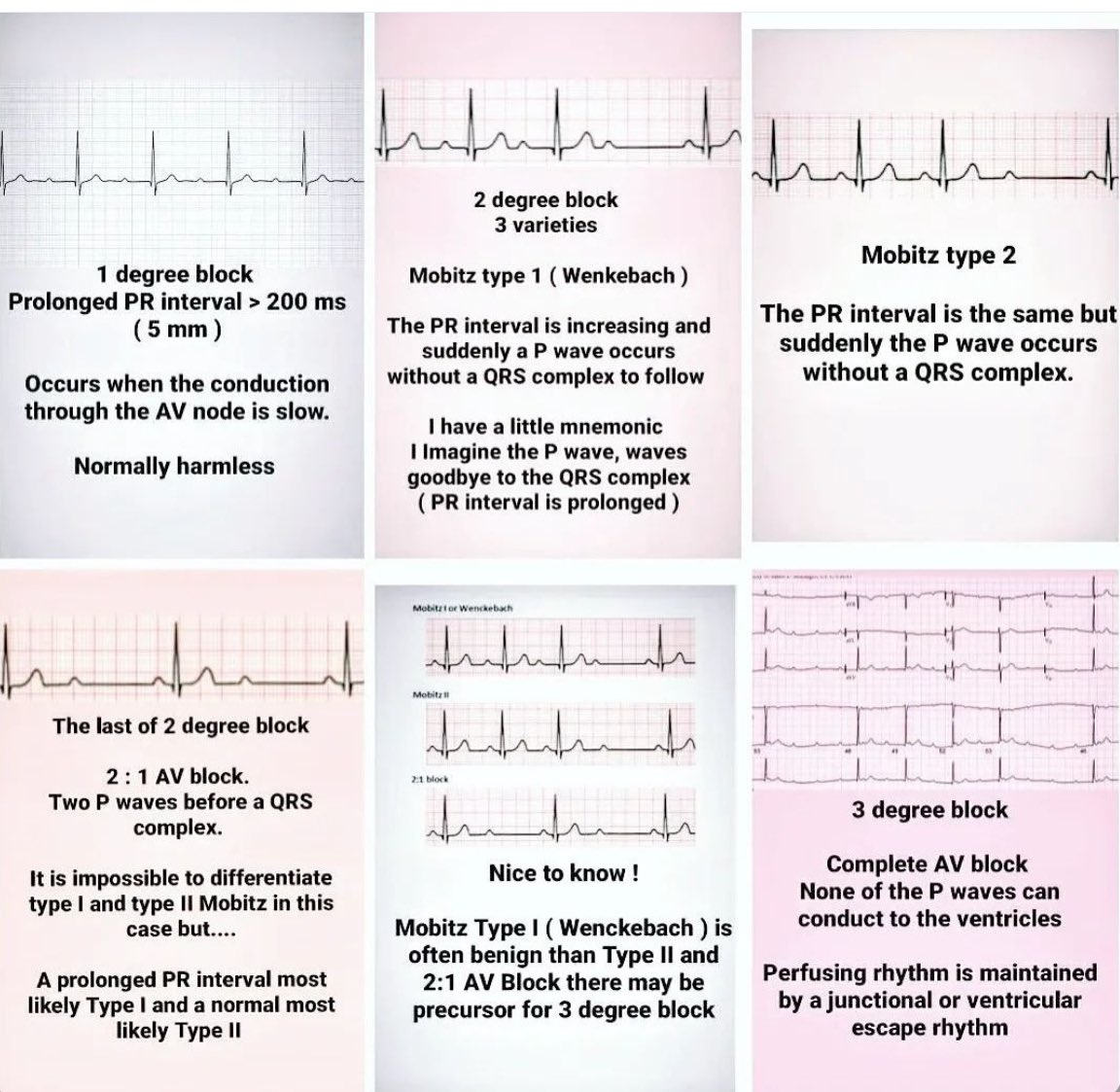 DrMedica_13's tweet image. Heart Blocks 🫀
#Types 

🩸🩸🩸
#MedEd #MedX #DDX #CardioMed