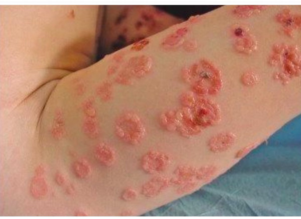 DrMedica_13's tweet photo. #Clinical_Case🦠
What is your diagnosis for this skin condition?
#MedEd #DermaMed #MedX https://t.co/rSrv59093Y