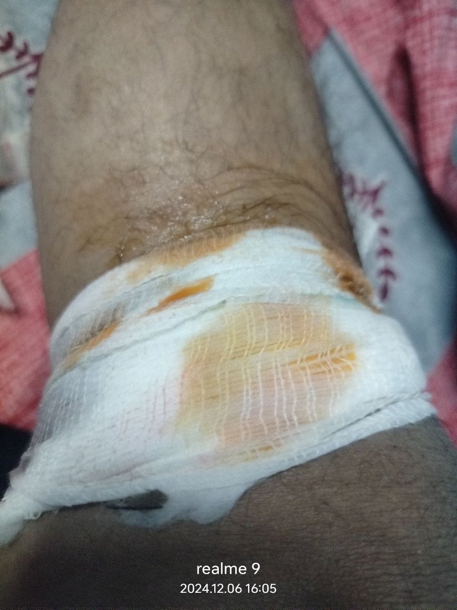 SinghS9775's tweet photo. साल भर मेहनत से पढ़ाई किए, लेकिन सर्वर डाउन होने के कारण फॉर्म नहीं भर पाया या पेमेंट नहीं हो पाया, और इसके लिए मांग करने पर ये हालत कर दिया गया है।

सत्ता पक्ष एवं विपक्ष, दोनों से निवेदन है कि अभ्यर्थियों का मांग माना जाए।

#Reopen70thBPSCForm
#दिलीप_कुमार_को_रिहा_करो https://t.co/hU8QZjv58U