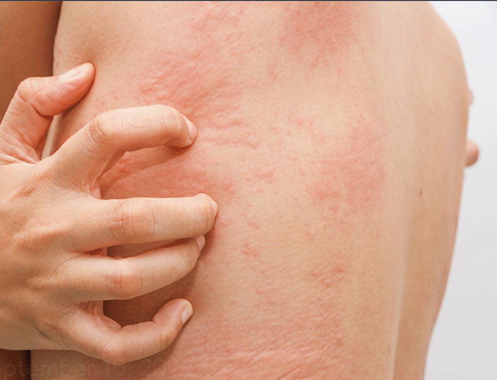 ALLERGIES 

Yesterday in the camp clinic, I noticed something unusual, almost everyone had been prescribed an antihistamine.

It made me wonder: What’s going on?
Why are so many people reacting?

Let’s talk about allergies, their triggers and how to stay safe. 👇🏼