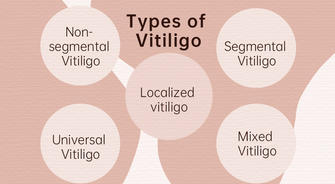 Anyone can develop vitiligo at any age. There is no prejudice in terms of who can develop the condition. Therefore, it can affect anyone, whatever their skin colour or ethnic origin, but will be more visually prominent in those with darker skin. #vitiligo