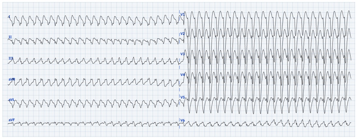 kaspar_86's tweet image. VT or SVT? Second ECG taken after prolonged tachycardia for 1.5 hours.
#Epeeps #EPfellows #ECGChallenge #CardioTwitter #Cardiology #ECG