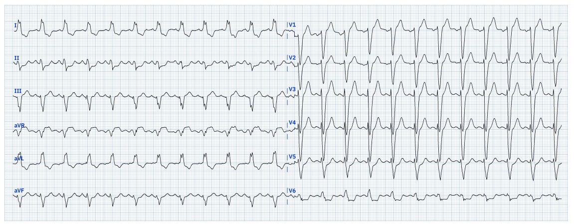 kaspar_86's tweet image. VT or SVT? Second ECG taken after prolonged tachycardia for 1.5 hours.
#Epeeps #EPfellows #ECGChallenge #CardioTwitter #Cardiology #ECG