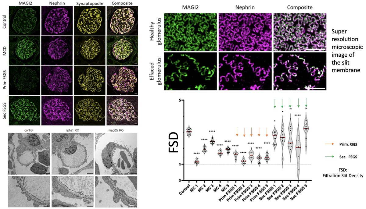 MAGI2, is a new biomarker for glomerulopathies! 🌟 This slit diaphragm protein is key to nephrin 🐙localization and causes effacement shown with our rapid zebrafish model. 🐟🔬
With MAGI2, we can distinguish primary from secondary FSGS!
As shown in our manuscript uploaded at