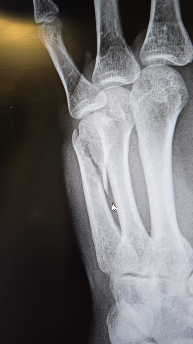 Tim83700309's tweet photo. Wiped out doing a wheelie and fractured my hand. I guess they ain't lying when they say the streets gotta eat. The bike is okay tho other than paint needing to be redone lol will be back in a month with more content lol https://t.co/l7i4YovO8S