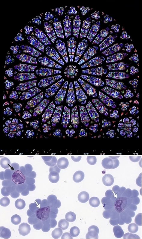 infeccHRUmalaga's tweet photo. Ha vuelto a ABRIR #NotreDame!!!🔥⛪️como homenaje recordar que #Malaria🦟🩸a veces forma estructuras en #roseton como el de la famosa catedral, en #Pfalciparum o #vivax posible mecanismo de escape a la #fagocitosis y destrucción en #BAZO
@NEJM 🔗👉🏻 https://t.co/tKIi8Jl3kP https://t.co/Heukli1zSA