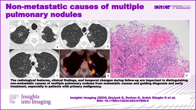 InsightsImaging's tweet photo. @cannella_rob π§βπ« Let's review the most common causes of non-metastatic pulmonary nodules!
Several diseases, including infections, inflammatory processes, and rare benign diseases, must be considered for differential diagnosis. https://t.co/N2cyRSBKIS