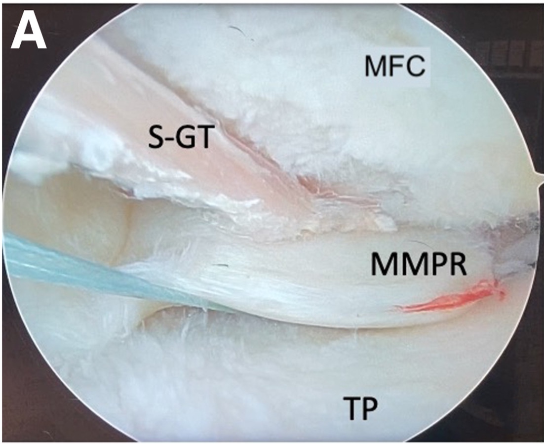 Transtibial Pullout for Medial Meniscus Posterior Root Reconstruction With Split-Gracilis Autograft #knee #arthroscopy #meniscus #root ow.ly/qxlU50UisHX