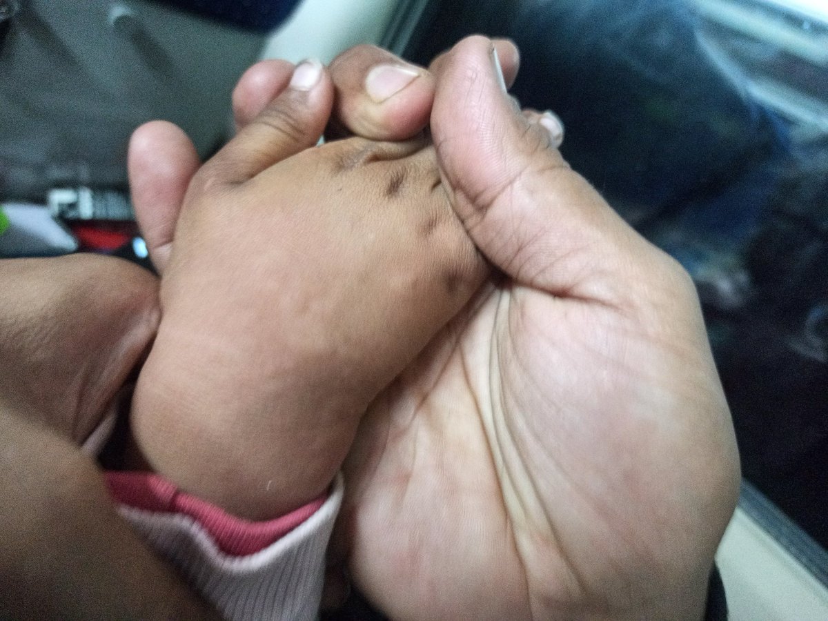 sachinsinghtech's tweet photo. Hi @RailwaySeva, My neice got allergy bumps on her body after boarding the Vande Bharat 22499, PNR 6807595766 https://t.co/ediLzWkwms