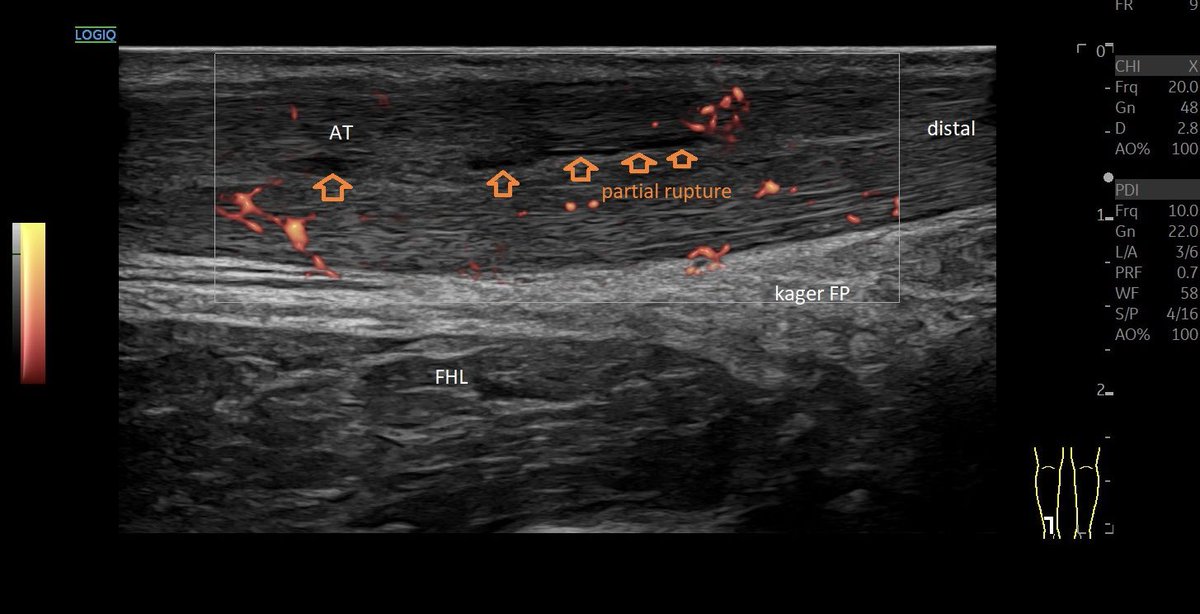 SportklinikBern's tweet photo. Tendinopathy of the #achillestendon with #partialrupture —> #ultrasoundguidedinjection with #arthrexprp ACP (2.6 x Tc concentration) - #mskus #pocus #pocushub #GElogiqE10sr4 https://t.co/NdL0rO4uEH