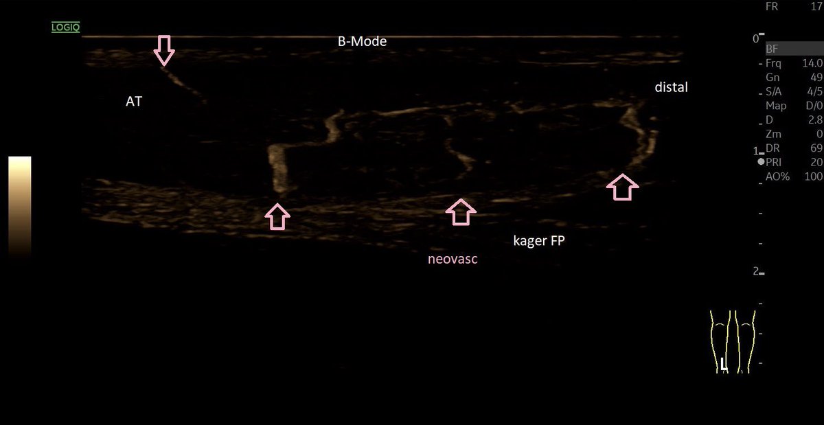 SportklinikBern's tweet photo. Tendinopathy of the #achillestendon with #partialrupture —> #ultrasoundguidedinjection with #arthrexprp ACP (2.6 x Tc concentration) - #mskus #pocus #pocushub #GElogiqE10sr4 https://t.co/NdL0rO4uEH