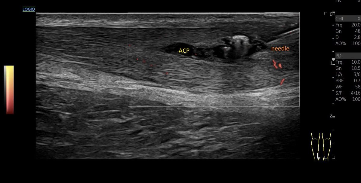SportklinikBern's tweet photo. Tendinopathy of the #achillestendon with #partialrupture —> #ultrasoundguidedinjection with #arthrexprp ACP (2.6 x Tc concentration) - #mskus #pocus #pocushub #GElogiqE10sr4 https://t.co/NdL0rO4uEH
