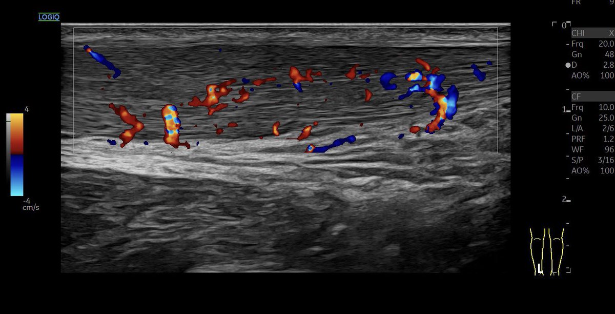 SportklinikBern's tweet photo. Tendinopathy of the #achillestendon with #partialrupture —> #ultrasoundguidedinjection with #arthrexprp ACP (2.6 x Tc concentration) - #mskus #pocus #pocushub #GElogiqE10sr4 https://t.co/NdL0rO4uEH