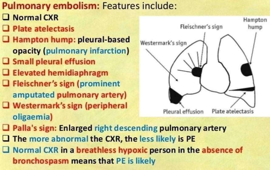 🔴 Revealing key signs of Pulmonary embolism on Chest X-ray 

1. Classic presentation is normal X-ray in patient with dyspnea and hypoxia
2. Atelectasis or parenchymal abnormality (68%)
3. Elevated hemidiaphragm

epomedicine.com/emergency-medi…
 #MedTwitter #MedEd #cardiotwiteros