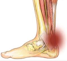 PTSultan_'s tweet photo. أخصائي #علاج_طبيعي تشتغل مع حالات التهاب/الم وتر اكيليس (العرقوب Achilles)؟ — 👇🏼هذي التوصيات العلميه الحديثه (2024) والمبنية على الادله العلميه الحديثه للتعامل مع هذه الحاله… 

#العلاج_الطبيعي 
#التمارين_العلاجية

https://t.co/ni7czlzuTL https://t.co/Zx5HGHPqar