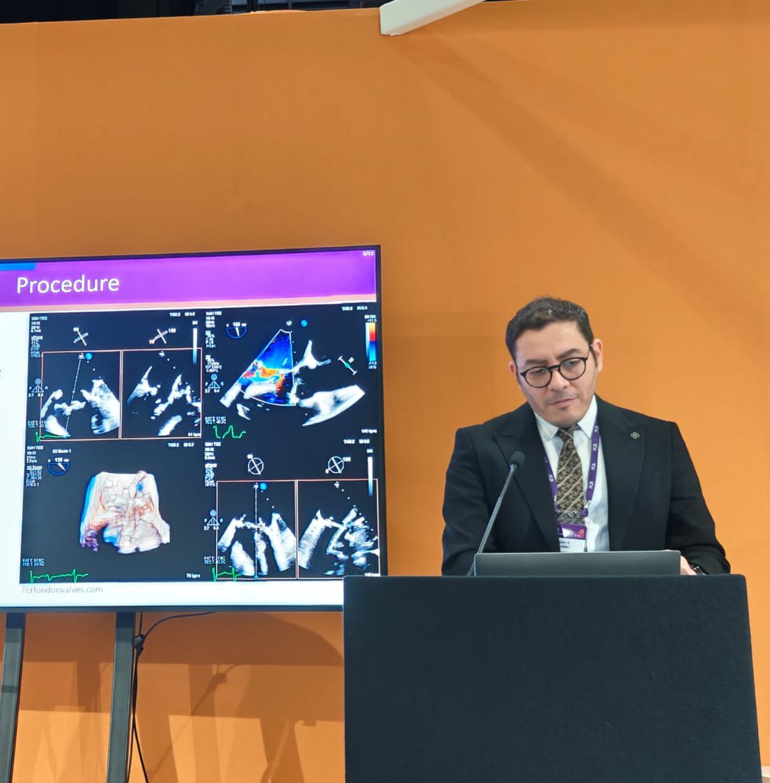 Pleased to have to have presented our experience with Transseptal BATMAN technique for high risk Mitral Valve in Ring at PCRLV 2024.
Many thanks <a href="/npfam1/">Neil Fam</a> and our great structural team for your support.
<a href="/PCRonline/">PCRonline 🫀</a>
