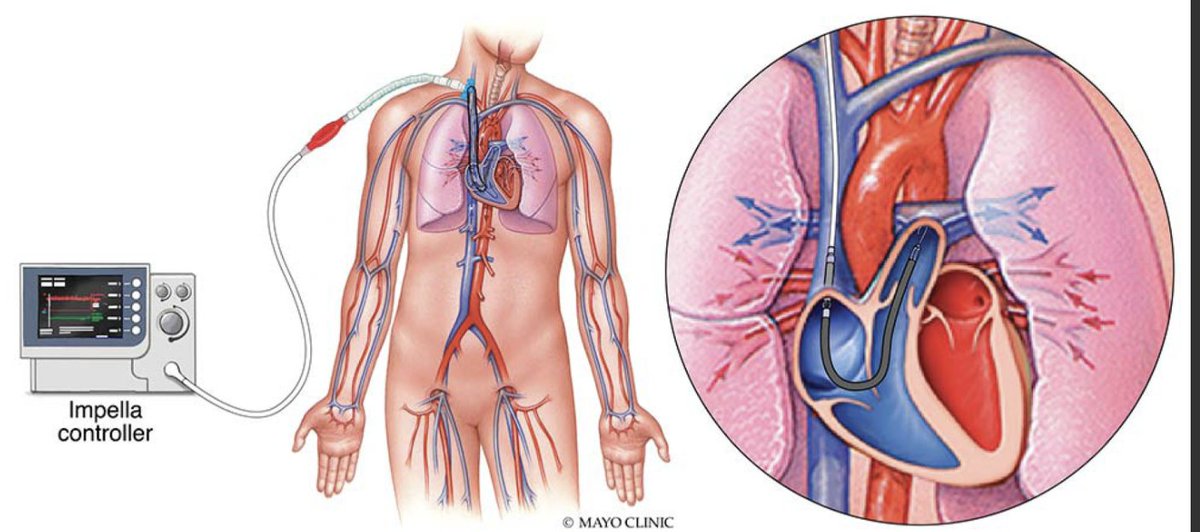 Journal of Cardiothoracic and Vascular Anesthesia (@jcvaonline) on Twitter photo 🚨Hot Off The Press
Mechanical Circulatory Support for Acute Myocardial Infarction Cardiogenic Shock: Review and Recent Updates - Journal of Cardiothoracic and Vascular Anesthesia
<a href="/CGSNabzdykMD/">Christoph G. S. Nabzdyk</a>
<a href="/MayoAnesthesia/">Mayo Clinic Department of Anesthesiology</a>
<a href="/pwierusz/">Patrick Wieruszewski</a>
<a href="/BrighamWomens/">Brigham and Women's Hospital</a>
<a href="/JCVAonline/">Journal of Cardiothoracic and Vascular Anesthesia</a>
<a href="/JuanGRipoll1/">Juan G. Ripoll, MD</a> 🚨Hot Off The Press
Mechanical Circulatory Support for Acute Myocardial Infarction Cardiogenic Shock: Review and Recent Updates - Journal of Cardiothoracic and Vascular Anesthesia
<a href="/CGSNabzdykMD/">Christoph G. S. Nabzdyk</a>
<a href="/MayoAnesthesia/">Mayo Clinic Department of Anesthesiology</a>
<a href="/pwierusz/">Patrick Wieruszewski</a>
<a href="/BrighamWomens/">Brigham and Women's Hospital</a>
<a href="/JCVAonline/">Journal of Cardiothoracic and Vascular Anesthesia</a>
<a href="/JuanGRipoll1/">Juan G. Ripoll, MD</a>