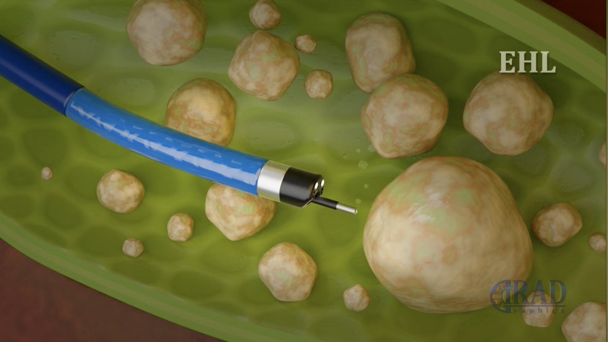 Nariman Nezami, MD (@nnezami1) on Twitter photo Made easy to understand by animation, Cholecystostomy and Cholangioscopy
youtu.be/hrkjrh8DWDE?si… via <a href="/YouTube/">YouTube</a> #Healthcare #MedicalInnovation <a href="/Georgetown_IR/">Medstar Georgetown IR</a> <a href="/Yale_IR/">Yale IR</a> <a href="/JohnsHopkinsIR/">Johns Hopkins IR</a> <a href="/hsinghIR/">Harjit Singh</a> <a href="/medravi/">Ravi Srinivasa</a> <a href="/uclaVIR/">UCLA IR</a> <a href="/SIRspecialists/">Society of Interventional Radiology</a> <a href="/cirsesociety/">CIRSE</a> <a href="/RSNA/">RSNA</a> Made easy to understand by animation, Cholecystostomy and Cholangioscopy
youtu.be/hrkjrh8DWDE?si… via <a href="/YouTube/">YouTube</a> #Healthcare #MedicalInnovation <a href="/Georgetown_IR/">Medstar Georgetown IR</a> <a href="/Yale_IR/">Yale IR</a> <a href="/JohnsHopkinsIR/">Johns Hopkins IR</a> <a href="/hsinghIR/">Harjit Singh</a> <a href="/medravi/">Ravi Srinivasa</a> <a href="/uclaVIR/">UCLA IR</a> <a href="/SIRspecialists/">Society of Interventional Radiology</a> <a href="/cirsesociety/">CIRSE</a> <a href="/RSNA/">RSNA</a>