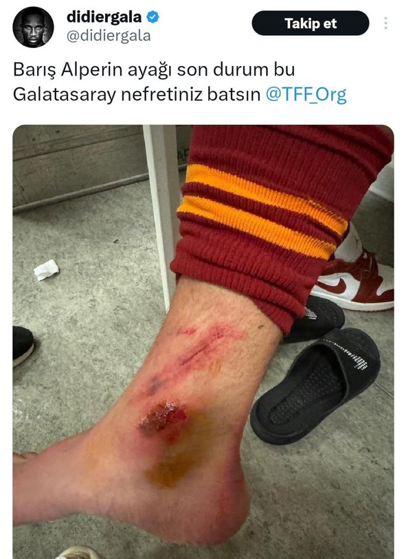 Nurizade1111's tweet photo. Barış Alper, müdahaleyi sol ayağına alıyor. Bunların paylaştığı fotoğrafta da sağ ayak gözüküyor. Her şeyleri yalan, her şeyleri dolan! https://t.co/Z6qjiz12oG