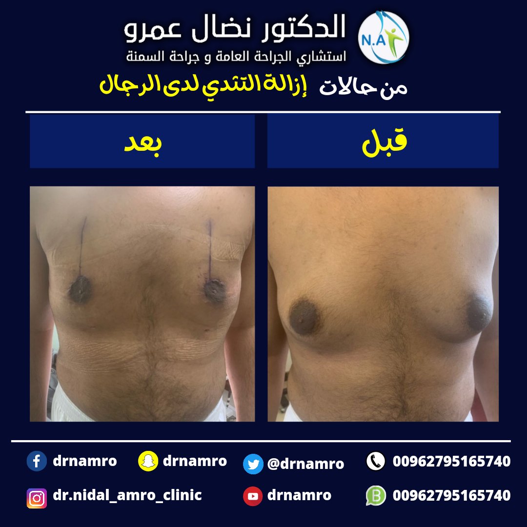 drnamro's tweet photo. من حالات إزالة التثدي لدى الرجال تمت بهذه النتيجة الرائعة بفضل الله د. نضال عمرو
استشاري الجراحةالعامة وجراحات السمنة
ممكن  التواصل مع الطبيب مباشره بالواتس عن طريق الرابط المباشر https://t.co/nkHUHPOqeK
واتس https://t.co/GmIvWXokg5
#التثدي #التثدي_عند_الرجال #نضال_عمرو https://t.co/dbj52UJz2Y
