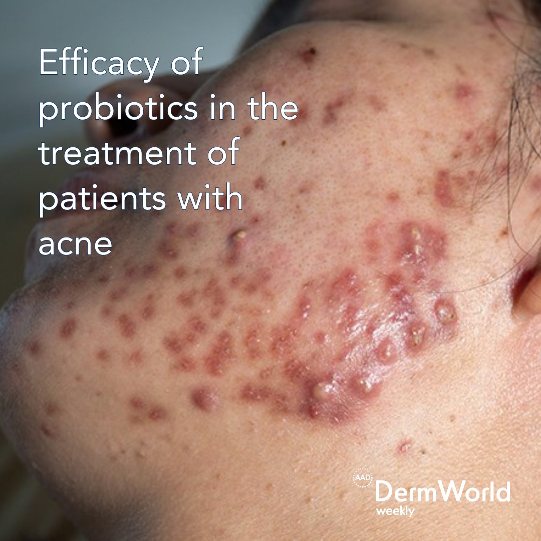 A review published in the Archives of Dermatological Research summarized data from clinical trials evaluating the efficacy of probiotics for the treatment of patients with acne vulgaris. Learn more in the AAD's #DermWorldWeekly - aad.org/dw/weekly/07-1…