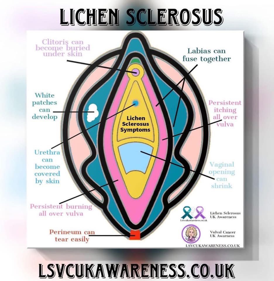 Lichen Sclerosus is a chronic skin condition that is often misdiagnosed as thrush or Genitourinary symptoms of menopause .
Know the signs and symptoms ⬇️