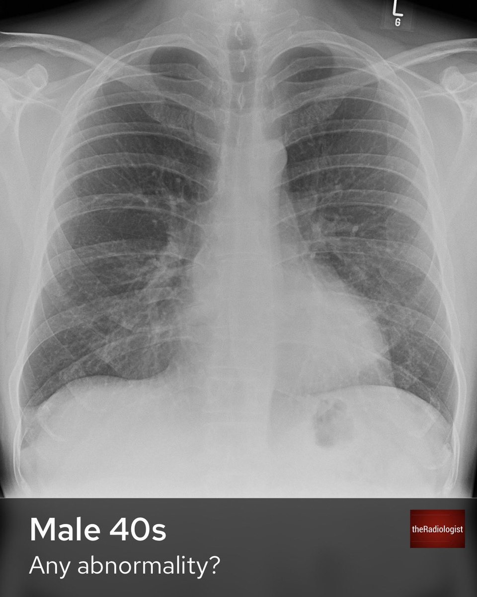 Male in his 40s has a chest X-Ray. Does it show anything?

Open thread for explanation