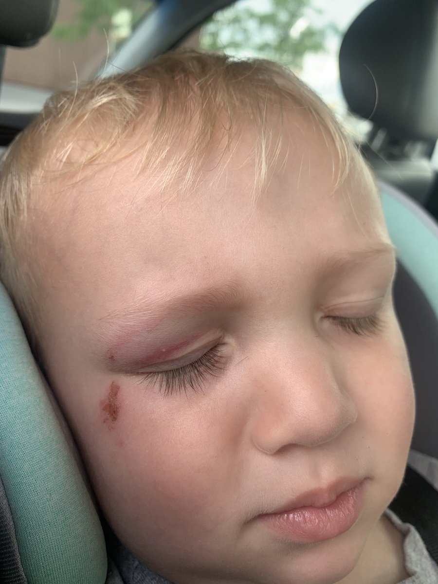 LeahCushmanNH's tweet photo. 🚨NH MOM NEEDS THE PUBLIC’S HELP🚨 

Please read and share.

@StephNoelle12 has been seeking redress for her grievances with the state for alleged negligent, abusive, arbitrary and capricious acts of maladministration by DCYF and the family court. Like so many others, she finds only dead ends. Her horrible story is only made worse by the fact that stories like hers are all too common. The public needs to know how bad the juvenile justice system is in NH and demand reform. 

The House had an opportunity to thoroughly investigate using its full power including sworn testimony and subpoenas if necessary and it was stopped first by the Republican Speaker of the House and then again by members of the House who voted against the motion in June to bypass  the corrupt gatekeeper and launch an investigation. The corruption in NH runs so deep and families are suffering as a result.

How many more parents must come begging for help? How many more kids have to be traumatized before the House fulfills its very first duty of redressing the grievances of the people? How many wrongful death lawsuits will it take? It is inexcusable for the servants of the people to receive these complaints year after year only to have this system continue its status quo of harming the innocent.

Please sign the petition at https://t.co/x6wUIeG1KB and share this post to raise awareness and demand investigation and reform. 

@StephNoelle12 is seeking help from the public to get justice for what she alleges DCYF and the family court have done and and are enabling her son to be abused. 

Please REPOST. 

She asked me to help her get the word out. These are her words and photos from her post on FB:

**TRIGGER WARNINNG** 

Child Physical Abuse Photos are in this post. 
MY 3 YEAR OLD SON IS IN DANGER AND I NEED THE PUBLIC’S HELP. PLEASE READ AND SHARE. 

I am Stephanie Turgeon, the mother of the child pictured below, Grayson Lee Draughon, born 6/12/21 in Nashua, New Hampshire. 

On 9/13/21 Grayson’s father was arrested out of our shared apartment in Manchester, NH where he was ultimately charged with 8 domestic violence charges against Grayson and I. We left that apartment that day and I have not been back.

9/15/21 I was awarded a temporary restraining order against Grayson’s father. At the final hearing for the restraining krder, Judge Kimberly Chabot denied the restraining order. To be fair, she did not hear the case, it was heard by a magistrate and then per the magistrates recommendation, Judge Chabot denied the restraining order at the final hearing. 

9/18/21 Grayson’s father was charged with stalking for sending me a text message that both violated his restraining order and his bail conditions. Even though he violated his bail conditions, they did not revoke his bail and he never served time in jail. 

At some point, I cannot remember the date, Judge Kimberly Chabot found Grayson’s father guilty of all 8 domestic violence charges. 

Grayson’s father utilized New Hampshire’s automatic appeal for misdemeanors and therefore was granted an automatic appeal for these charges. We then had a jury trial and the jury found him guilty of 2 charges including endangering the welfare of Grayson by pulling on his arms trying to get him out of my grip so he could punch me in the face. I learned from the prosecutor that Domestic Violence is notoriously the hardest to prove in front of a jury and is the most likely to be acquitted. 

Grayson’s father was found guilty of the stalking charge and then ultimately plead guilty to it after he appealed it for a jury trial. His sentence was handed down from judge Delker and the sentence he received for talking to me after he was ordered not to was to not talk to me except as is permitted by the family court. If that doesn’t make sense it’s because it doesn’t make sense. 

In February of 2022 we had our first family court date, initiated by Grayson’s father. You’ll notice a picture below of hundreds of white pills and used and unused needles. I found these drugs after my son was already born and Grayson’s father admitted he has had a bad opioid addiction since he was a teenager. 

These pictures were presented at this court date and Judge Bradley Lown “made a finding” that these pictures were all “flea and tick medicine”. No, Judge Lown did not order any tests on the drugs this was just his opinion based on the pictures. Once a court “makes a finding” you can’t use it as evidence anymore that Grayson’s father is using drugs. 

Grayson’s father had to do supervised visits so that he could start a relationship with Grayson. They began in July of 2022 for 2 hours a week. 
August of 2022, Focus on Families (the supervision center) sent an email stating that Grayson’s father was very argumentative and was talking badly about me to Grayson and that she had to redirect Grayson’s father several times. She went on to say that if the behavior happens 1 more time she will not be doing his visits anymore. Grayson’s father did not show up to his court ordered supervised visits ever again after this day. 

10/6/22 I did not have an attorney for this one hearing. Judge Bradley Lown was informed of the details that occurred during the supervised visits and how Grayson’s father did not follow the court’s order and stopped attending. Judge Bradley Lown then awarded Grayson’s father overnight visits effective that day on Thursday 10/6/22 at 4pm until Sunday 4pm and then every Tuesday 12pm- 4pm to continue every single week. I work Monday - Friday. Grayson’s father does not work as he has “total disability” from the military for mental health reasons. 
When Grayson’s father arrived at the daycare he was not given Grayson because he had no paperwork showing that he could pick Grayson up. The cops were called because of his aggression and because he snuck in to the daycare facility that is locked down and only accessible to those with a “key card”. 

10/7/22 Grayson’s father was trespassed from his daycare for aggressive behavior. He also had a 2 hour stand off in the parking lot with the Nashua police. He then got an ex-parte order that ordered me to give my son to him immediately or I would be arrested on the spot, signed by Judge Bradley Lown. 

I was held in contempt at the end of October that year and the new parenting plan was my punishment that I would have 2.5 days a week and he would have 4.5 days a week, I had to do all of the travel to every exchange and again he had every single weekend. 

February 2023 Grayson’s father was trespassed from St. Joes Pediatrics in Nashua for his aggressive behavior and they let Grayson go as a patient all together because of the incident.

That schedule went on for 10 months and during that 10 months there was about 6 different DCYF investigations in to Grayson’s father based on the pics below. Since he refused to talk to them they just closed the case every time. 

8/28/23 NHDCYF filed an abuse/neglect petition against Grayson’s father which was substantiated by Judge Ellen Joseph on or around November 15, 2023 after an expert in child abuse evaluated Grayson and testified that he was not safe with his father. 

This resulted in Grayson staying with me full time while his father worked what is called “reunification”.  I paid $300/hr for my attorney while Grayson’s father had a free attorney since he was the “petitioned parent” on the case. 
NHDCYF chose to close the case early and refused to give me or the court appointed special advocate (CASA) any answers as to what they had done with Grayson’s father to correct the conditions that lead to this finding against him. He was not ordered to do any drug testing even though he is an admitted addict taking suboxone nor was he made to do any parenting classes. Judge Ellen Joseph denied my attorney’s and the CASA’s filings and granted NHDCYF filings closing the case effective immediately reverting our parenting plan back to me having 2.5 days a week and him having 4.5 days week etc etc. 

TO THIS DAY MY SON IS NOT SAFE. He came back with another black eye a few weeks ago and DCYF is trying to cover it up. TO THIS DAY Grayson’s father has more time with him than I do. TO THIS DAY I have had 1 motion granted in my favor (it was pertaining to the Guardian Ad Litem’s  bill) and Grayson’s father has had every single solitary motion he has filed has been granted. Every single one. The motion I had granted in my favor was one motion he never objected to. So quite literally, every single solitary motion he has filed has been fully granted. 

In June of this year, I was diagnosed with PTSD and anxiety due to this situation. 2 conditions I have never had before. 

The court of public opinion is still the highest in the land. Please share this if you think that abusive parents should not be the primary care taker of children. 

Please share this if you think that the entity charged with protecting children should NOT be the entity that profits financially off of children being unsafe. 

I’ve spoken to NH state reps and an executive council member and sentors. These people hear me loud and clear and agree with me but have mentioned how the corruption is just so deep and that the public just does not know what is really going on. 

I am asking the public to make noise because that’s all we have at this point. 

#justiceforgrayson #metoofamilycourt #FamilyCourtReform #FamilyCourtCorruption #dcyf #nhdcyf #cottageindustry #endchildabuse #childrensrightsmatter #childrensrights #childrensrightsarehumanrights #harmonymontgomery #GraysonDraughon 
#alienationindustry #onemomsbattle 
#PTSD #NarcissticAbuse