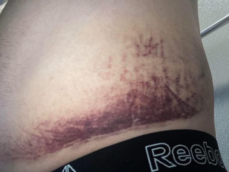 thesargecc's tweet photo. Bruising is setting in. Four broke ribs from the chair. It’s going to be awhile for me to be at 100%, but it won’t stop me. I AM the toughest sonuvagun in High Ground Pro Wrestling! You fight through the pain. No hate. No revenge. Just fight. I will have my reckoning! HURA! https://t.co/ggwHx3HOp1