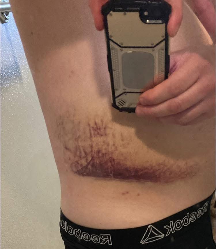 thesargecc's tweet photo. Bruising is setting in. Four broke ribs from the chair. It’s going to be awhile for me to be at 100%, but it won’t stop me. I AM the toughest sonuvagun in High Ground Pro Wrestling! You fight through the pain. No hate. No revenge. Just fight. I will have my reckoning! HURA! https://t.co/ggwHx3HOp1