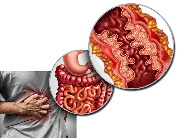 NewsMedical's tweet photo. Filgotinib offers new promise for managing Crohn’s disease 🌟💊🌍 https://t.co/NsVBBCCxaZ #CrohnsDisease #Filgotinib #JAKInhibitor #ClinicalTrials #Gastroenterology #Health #Medical #PatientCare @LancetGastroHep https://t.co/IcK1wQwsDt