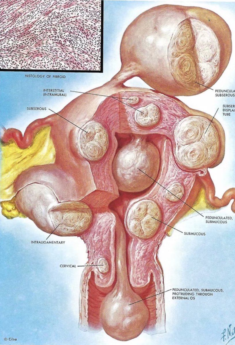 WHY ARE FIBROIDS SO COMMON?

Fibroids affect 70-80% of women by age 50.

Is this cause for alarm?

How can they be identified on time?
What are the key symptoms?
Can they be prevented?

Everything you need to know. 👇🏼