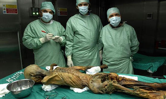Ayrıca Ötzi’nin arka dişlerinden birinde muhtemelen yediği tahılların arasına karışmış olan bir taşın neden olduğu büyük bir kırık saptandı.
Araştırmacılar, Ötzi’nin yanında bir yay, 14 ok, bir bıçak ve bakır bir balta taşıdığını tespit ettiler.