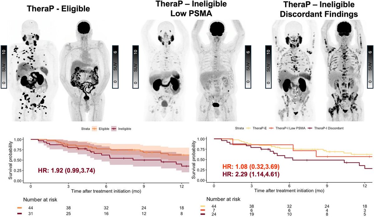 JournalofNucMed's tweet image. Among PET-based VISION-eligible patients, TheraP-I patients had shorter PSA-PSA and OS, which was mainly driven by discordant findings between PSMA PET and ¹⁸F-FDG PET. ow.ly/mrjR50U9Bhm 

#NuclearMedicine #ProstateCancer @DrAIravani