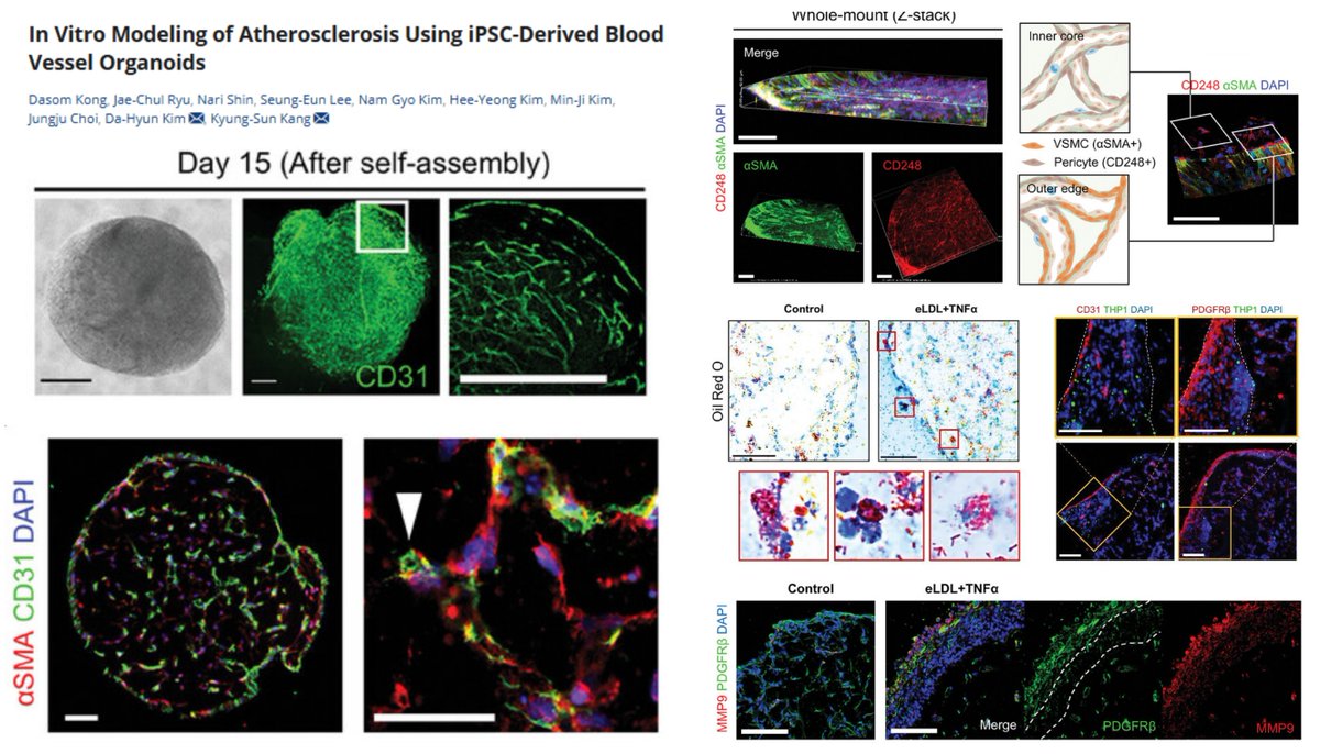 Inflammed #hiPSC Blood Vessel #Organoid as a drug screening platform for #Atherosclerosis

Spinning shear stress, eLDL/TNFα/IL1β, monocytic THP1 cell co-culture->
⏫ICAM1/TNFα/VCAM1/iNOS
⏬pS1177 eNOS (likely in both #EndothelialCell &amp; mural cell, except E-selectin in EC only)