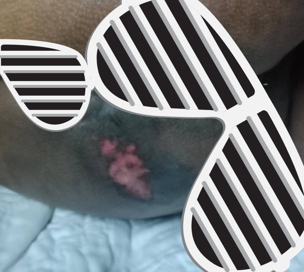 fae_manan's tweet photo. 43yo previously ADL independent &amp; very fit. Dx: multiple myeloma in sept 24 now shes bed bound&amp;her sacral sore becoming worse to worst.Nt compliant to 2hourly turning &amp;she ws discharged frm rehab WITHOUT ripple matress. 
1st :14/11/24
2nd :2/12/24
3rd: today
4th: I bought these https://t.co/emPGOeBtDp