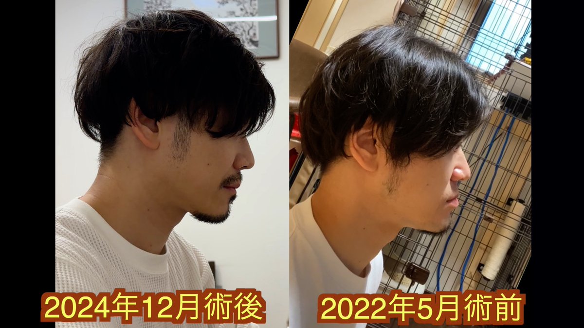 手術を受けた病院での最後の経過観察が終わった
これでやっと無罪放免
終わってみるとあっという間の出来事でしたが,いい経験ができました
顔貌も概ね満足だし噛み合わせも完璧と思う
顔の痺れや麻痺は多少残ってますが生活に支障のないレベルです

これから治療される方々頑張ってくださいね
お先です