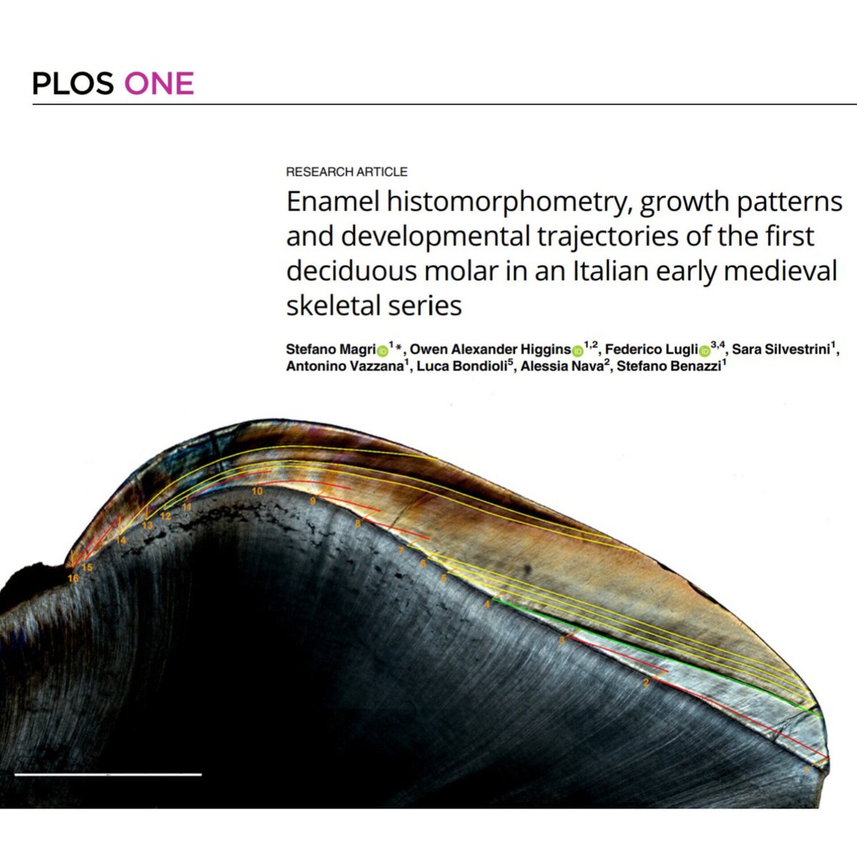 BonesLab (@boneslabunibo) on Twitter photo We’re thrilled to announce our latest results from the histological analyses on the first deciduous molars from two Early-Medieval necropolises, now available on PLOS One!
<a href="/LFAnthropology/">Federico Lugli</a> <a href="/stefano_benazzi/">Stefano Benazzi</a>
<a href="/OnHig/">Owen</a> <a href="/BIOANTH_Lab/">MOTHERS Project</a>
journals.plos.org/plosone/articl… We’re thrilled to announce our latest results from the histological analyses on the first deciduous molars from two Early-Medieval necropolises, now available on PLOS One!
<a href="/LFAnthropology/">Federico Lugli</a> <a href="/stefano_benazzi/">Stefano Benazzi</a>
<a href="/OnHig/">Owen</a> <a href="/BIOANTH_Lab/">MOTHERS Project</a>
journals.plos.org/plosone/articl…