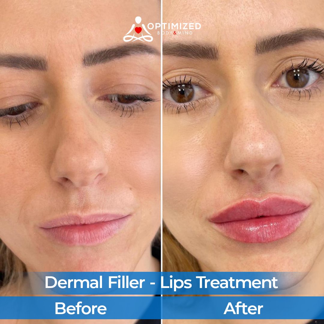 OptimizedBandM's tweet photo. Enhance your lips with trusted experts at Optimized Body &amp; Mind💉💋

💥 Limited Time Offer:
Now £𝟏𝟏𝟓 (was £190) – Get up to 40% OFF

📅 Book Your Lips Fillers Appointment Today:
👉 https://t.co/rU9hySiKDa

#optimizedbodyandmind #dermalfiller #lipfillers #luton #beforeandafter https://t.co/YzL6NfijGy