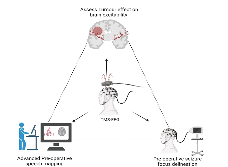 KingsNeuro's tweet photo. We have published a concept paper on "Transcranial Magnetic Stimulation–Electroencephalography (TMS-EEG) in Neurosurgery: Unexplored Path Towards Personalized Brain Surgery" @MDPIOpenAccess JPM.

https://t.co/zKa98WQto6

@lavrador_jose @AsfandBm @PrazNeuro @feras199 @Sabzp87 https://t.co/BBLP5LajZa