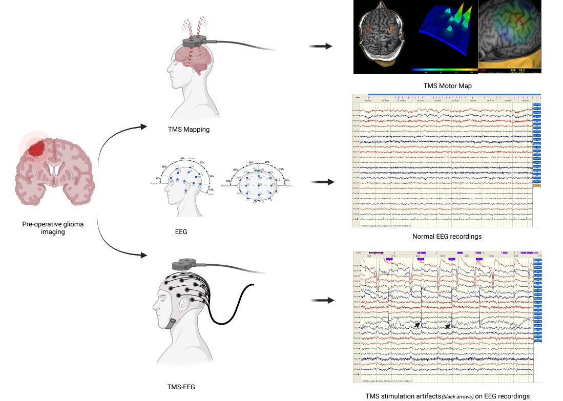 We have published a concept paper on "Transcranial Magnetic Stimulation–Electroencephalography (TMS-EEG) in Neurosurgery: Unexplored Path Towards Personalized Brain Surgery" <a href="/MDPIOpenAccess/">MDPI</a> JPM.

mdpi.com/2075-4426/14/1…

<a href="/lavrador_jose/">José Pedro Lavrador</a> <a href="/AsfandBm/">Asfand Baig Mirza</a> <a href="/PrazNeuro/">Prajwal Ghimire</a> <a href="/feras199/">Feras Fayez</a> <a href="/Sabzp87/">Sabina</a>