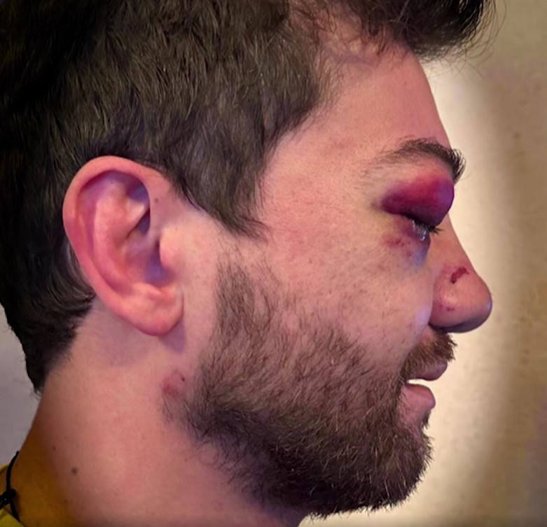 Publika_ge's tweet photo. 1/ This is Saba Kevkhishvili, who was beaten by the police at dawn on December 1. He had injuries to his face, including fractures to his nose, jaw, and eye socket, as well as a concussion. https://t.co/uMQ11ysbmT
