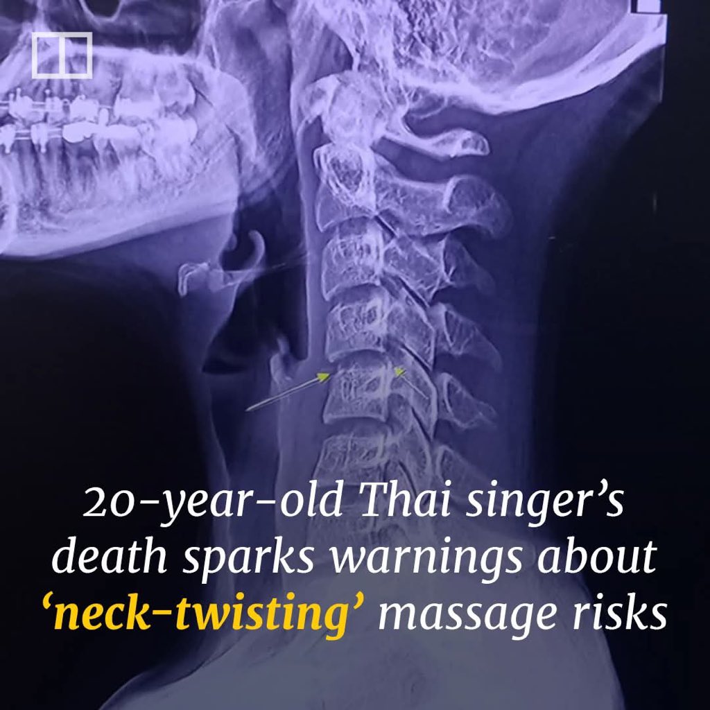 EddyConsult's tweet photo. #Necktwisting- Be it neck twisting massage or chiropractor massaging your neck , just know this can turn out to be bad for you , hence caution . You need to know how vascularized the neck and major vessels that control the neck muscles work . 📣The cervical spine is the most superior portion of the vertebral column, lying between the cranium and the thoracic vertebrae. A fracture common in the neck region is called the ♠️Hangman’s fracture ,fracture of the pars interarticularis (bony column between the superior and inferior articular facets of the axis). It typically occurs as a result of high velocity hyperextension and distraction of the head, hence rupture of the spinal cord , respiratory failure , cardiac failure sets in . 👑The spinal nerves are intimately related to the cervical vertebrae. The transverse foramina of the cervical vertebrae provide a passageway by which the vertebral artery, vein and sympathetic nerves can pass. The only exception to this is C7 – where the vertebral artery passes around the vertebra, instead of through the transverse foramen.Hence a damage to the vertebral artery during neck twisting or aggressive massage may lead to ♦️cervical artery dissection♦️,meaning a tear in the vertebral artery as well as carotid artery will result to formation of blood clots with onset of ♦️stroke♦️ .